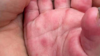 夏季手足口病高发 拒绝无效消毒 专属居家消毒指南