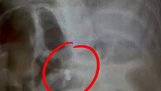 三岁男童误吞磁力珠 奶奶轻视 医生紧急呼吁送医