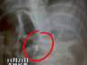 三岁男童误吞磁力珠 奶奶轻视 医生紧急呼吁送医