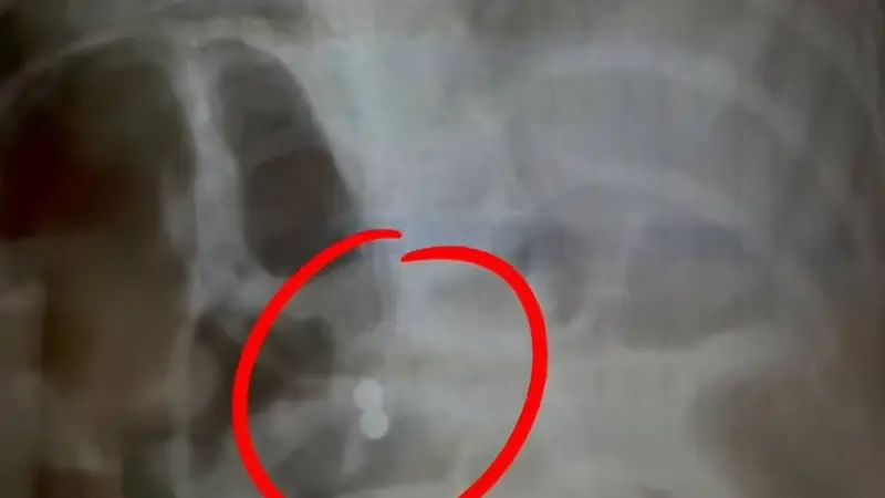 三岁男童误吞磁力珠 奶奶轻视 医生紧急呼吁送医